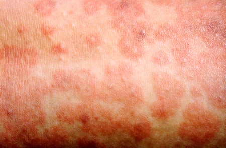 A picture of a rash caused by measles resulting in large red welts