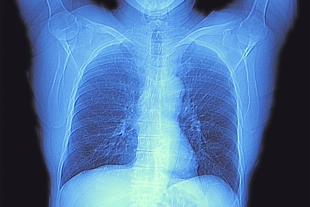 Computed tomography (CT) scan of the chest of an healthy adult, showing normal lungs